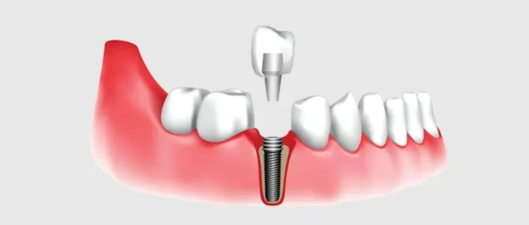 چگونه از دندان ایمپلنت نگهداری کنیم؟