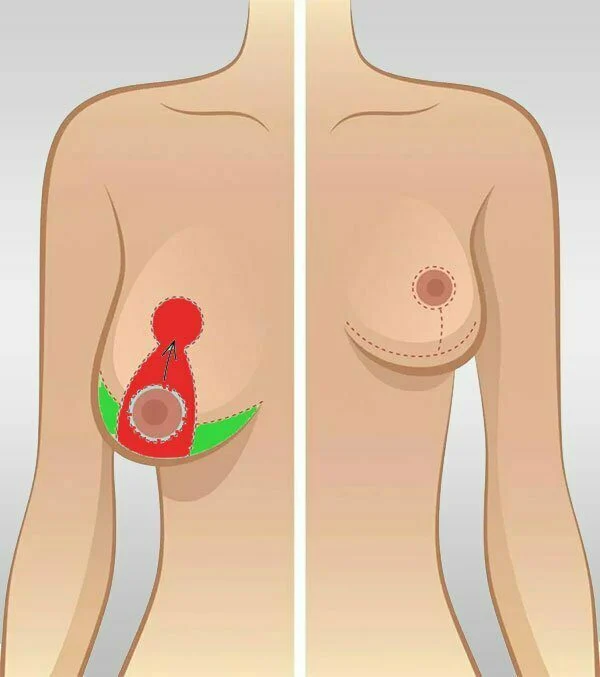 What to eat after mammoplasty