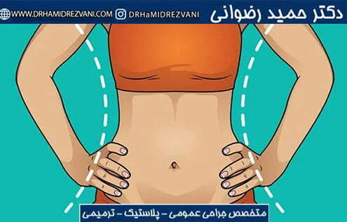 Abdo postoperative complications