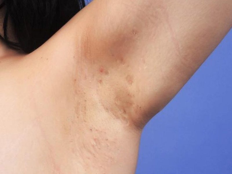 All kinds of underarm skin diseases
