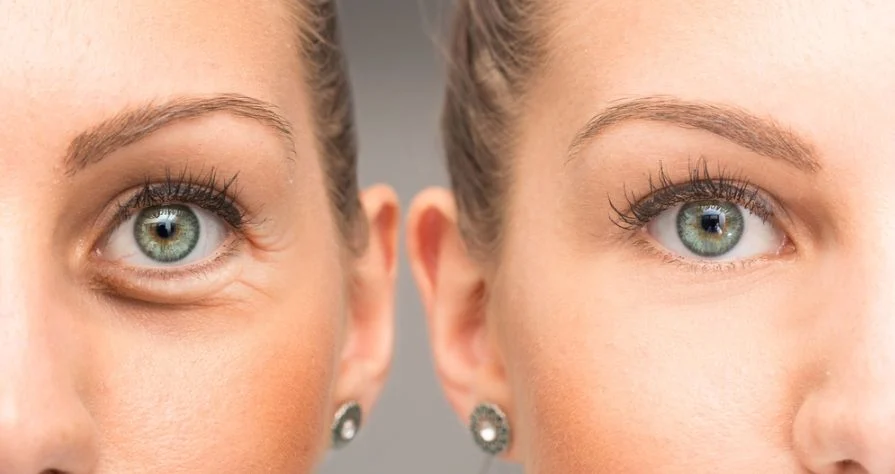 What can we do to get rid of wrinkles around the eyes?