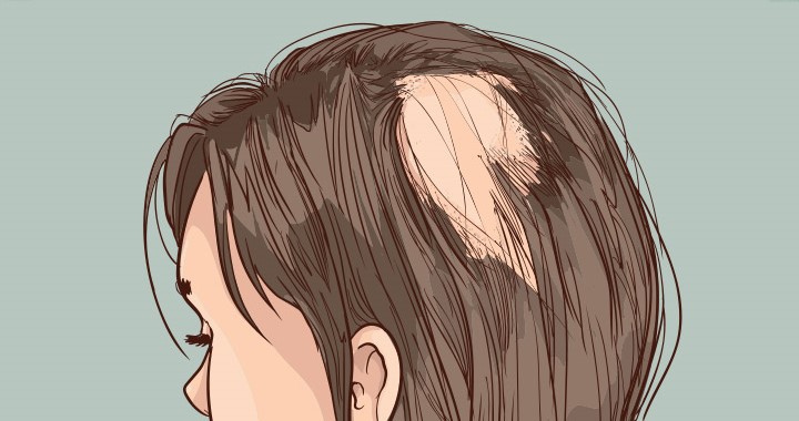 What is the real cause of hair loss and is it dangerous?