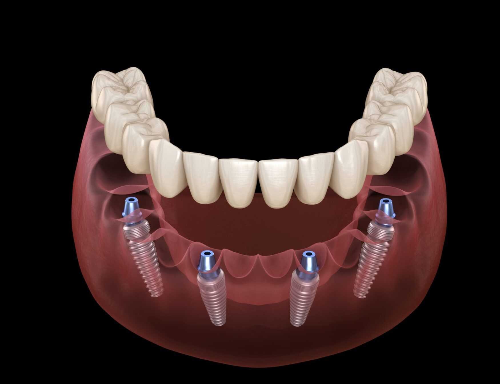 Dental prosthesis